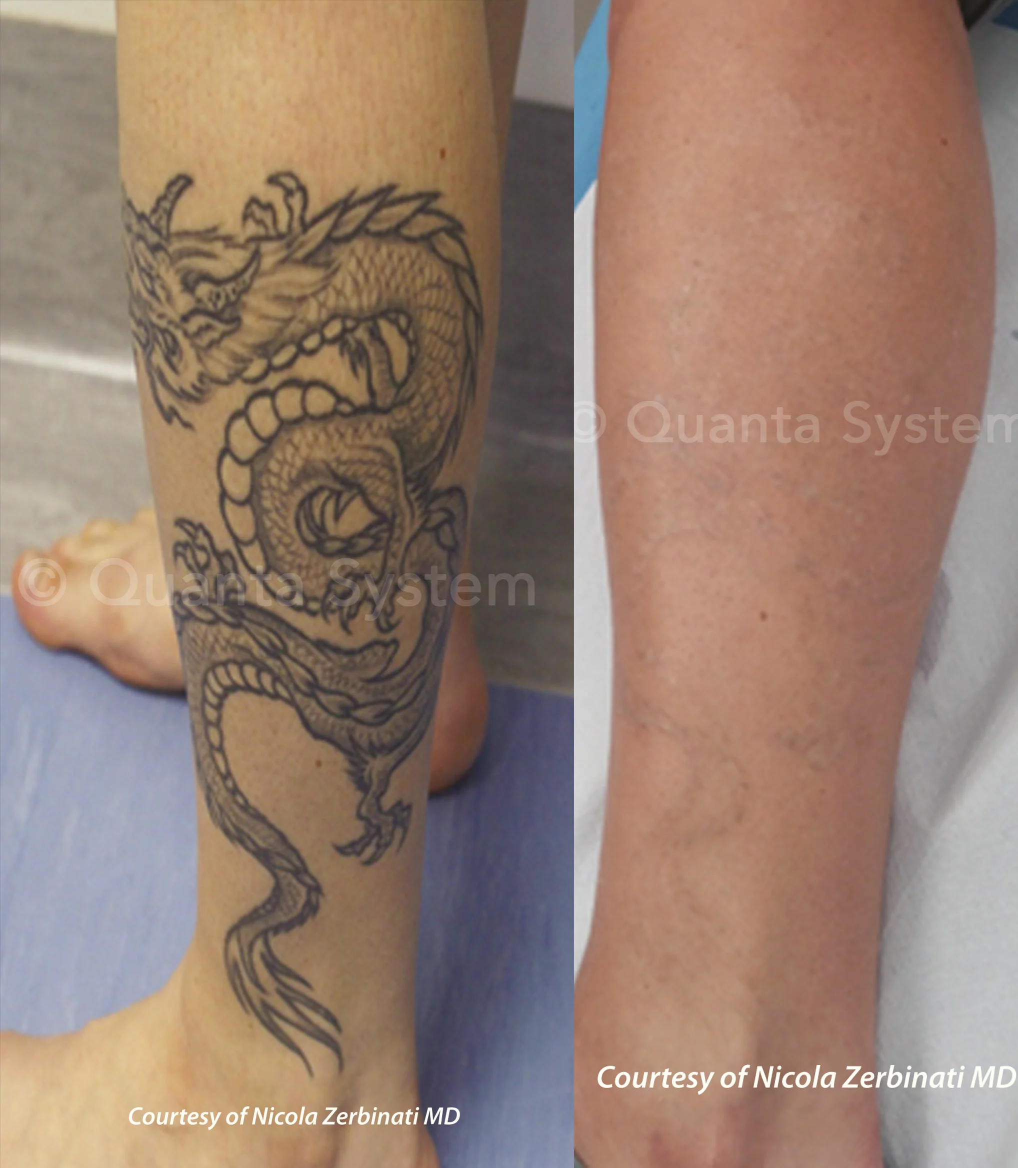 tatueringsborttagning-före-och-efter